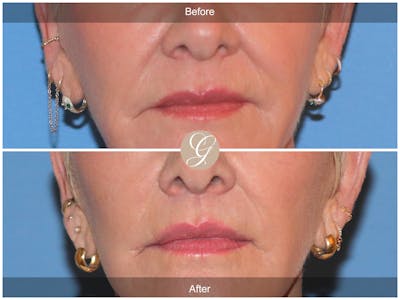 Lip Lift Before & After Gallery - Patient 259946 - Image 1