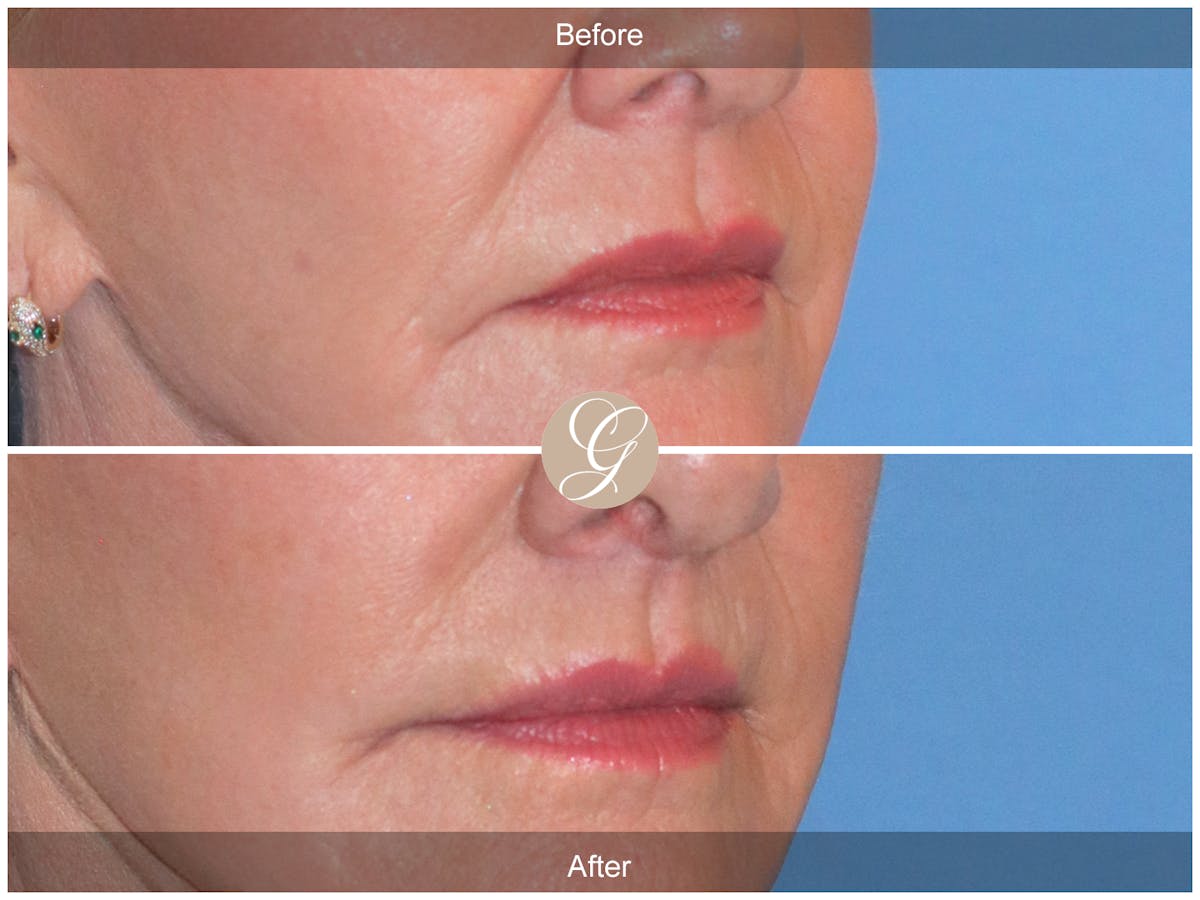 Lip Lift Before & After Gallery - Patient 259946 - Image 2