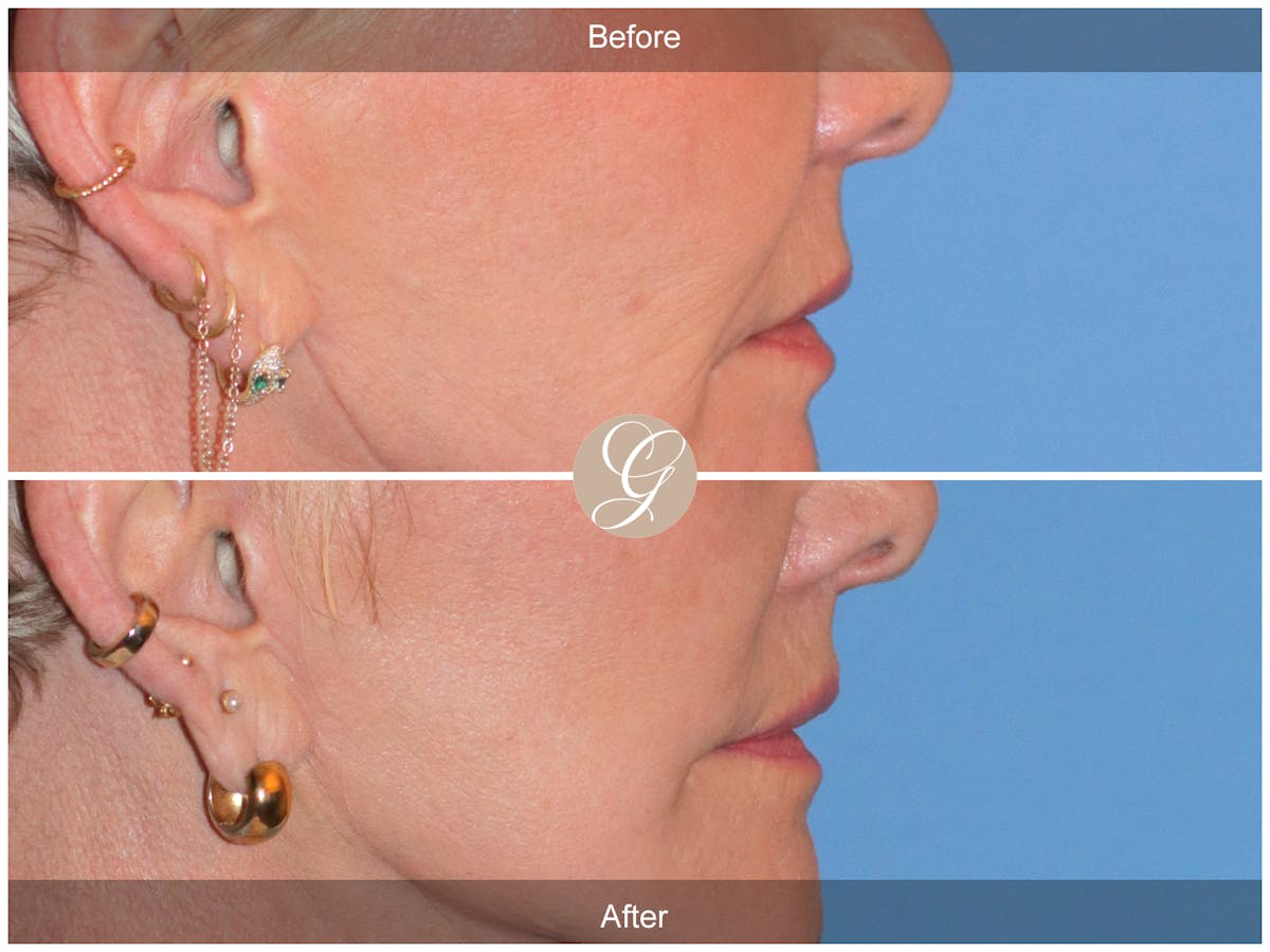 Lip Lift Before & After Gallery - Patient 259946 - Image 3
