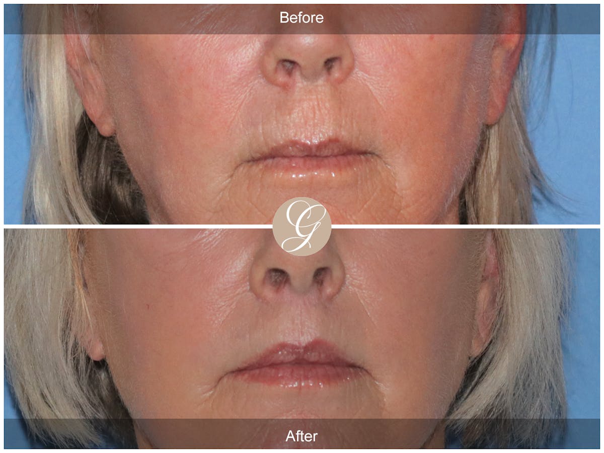Lip Lift Before & After Gallery - Patient 255791 - Image 1