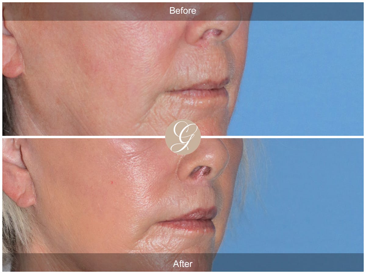 Lip Lift Before & After Gallery - Patient 255791 - Image 2