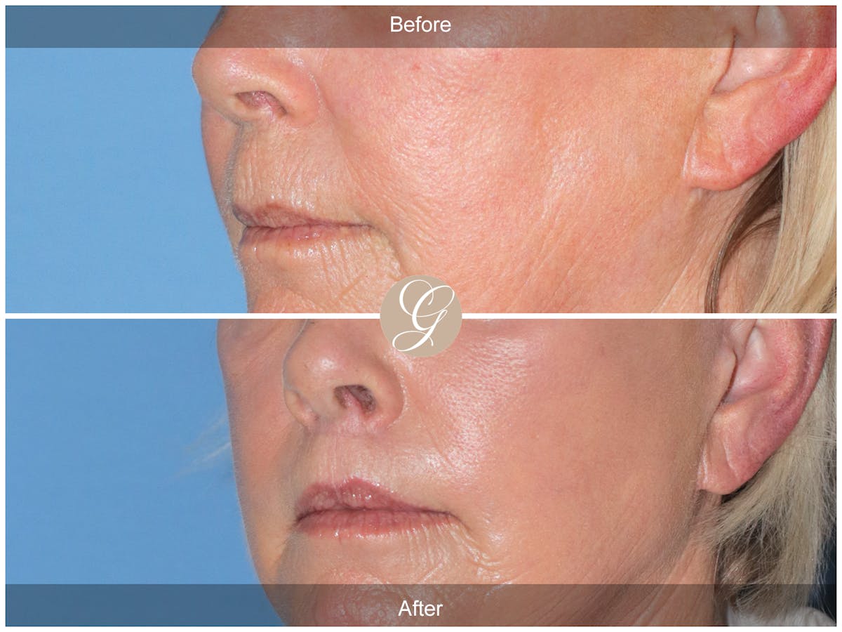 Lip Lift Before & After Gallery - Patient 255791 - Image 3