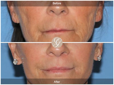 Lip Lift Before & After Gallery - Patient 314096 - Image 1