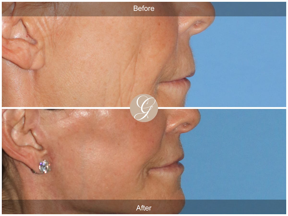 Lip Lift Before & After Gallery - Patient 314096 - Image 3