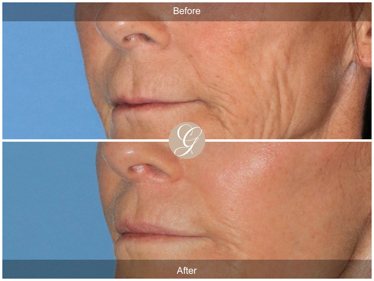 Lip Lift Before & After Gallery - Patient 314096 - Image 2