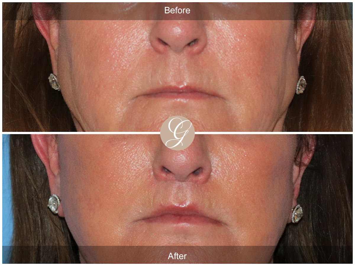 Lip Lift Before & After Gallery - Patient 282535 - Image 1