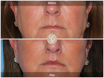 Lip Lift Before & After Gallery - Patient 282535 - Image 1
