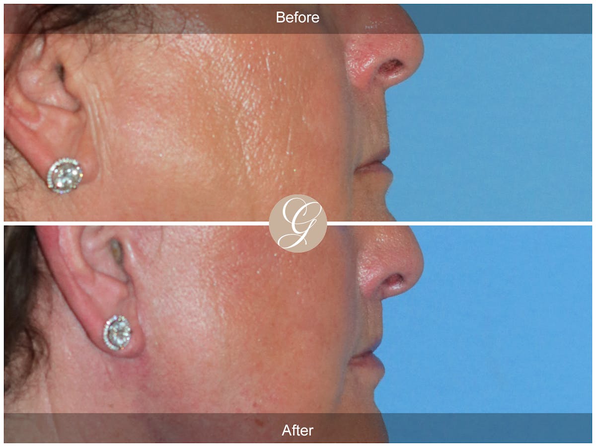 Lip Lift Before & After Gallery - Patient 282535 - Image 3