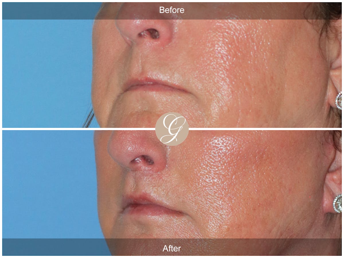 Lip Lift Before & After Gallery - Patient 282535 - Image 2