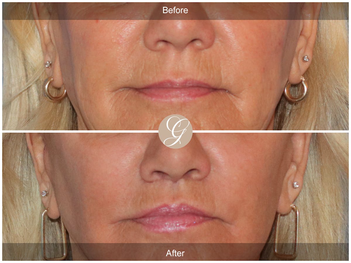 Lip Lift Before & After Gallery - Patient 332552 - Image 1