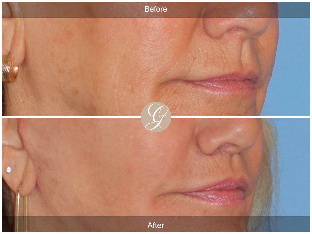 Lip Lift Before & After Gallery - Patient 332552 - Image 2