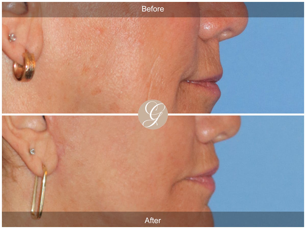 Lip Lift Before & After Gallery - Patient 332552 - Image 3