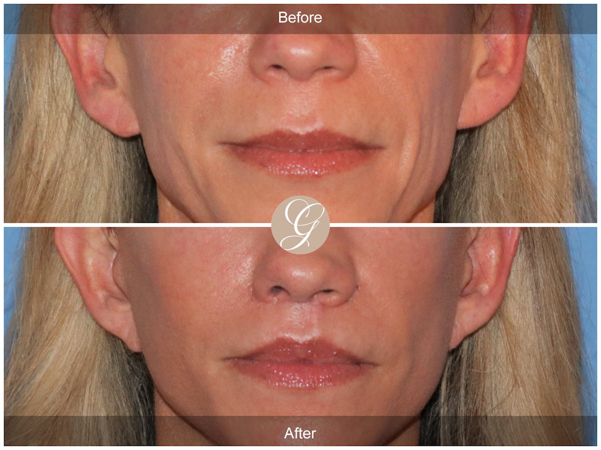 Lip Lift Before & After Gallery - Patient 198068 - Image 1