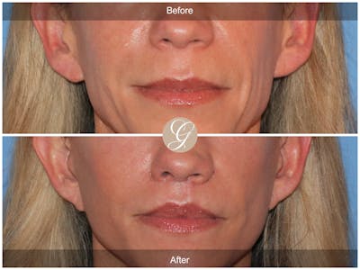 Lip Lift Before & After Gallery - Patient 198068 - Image 1