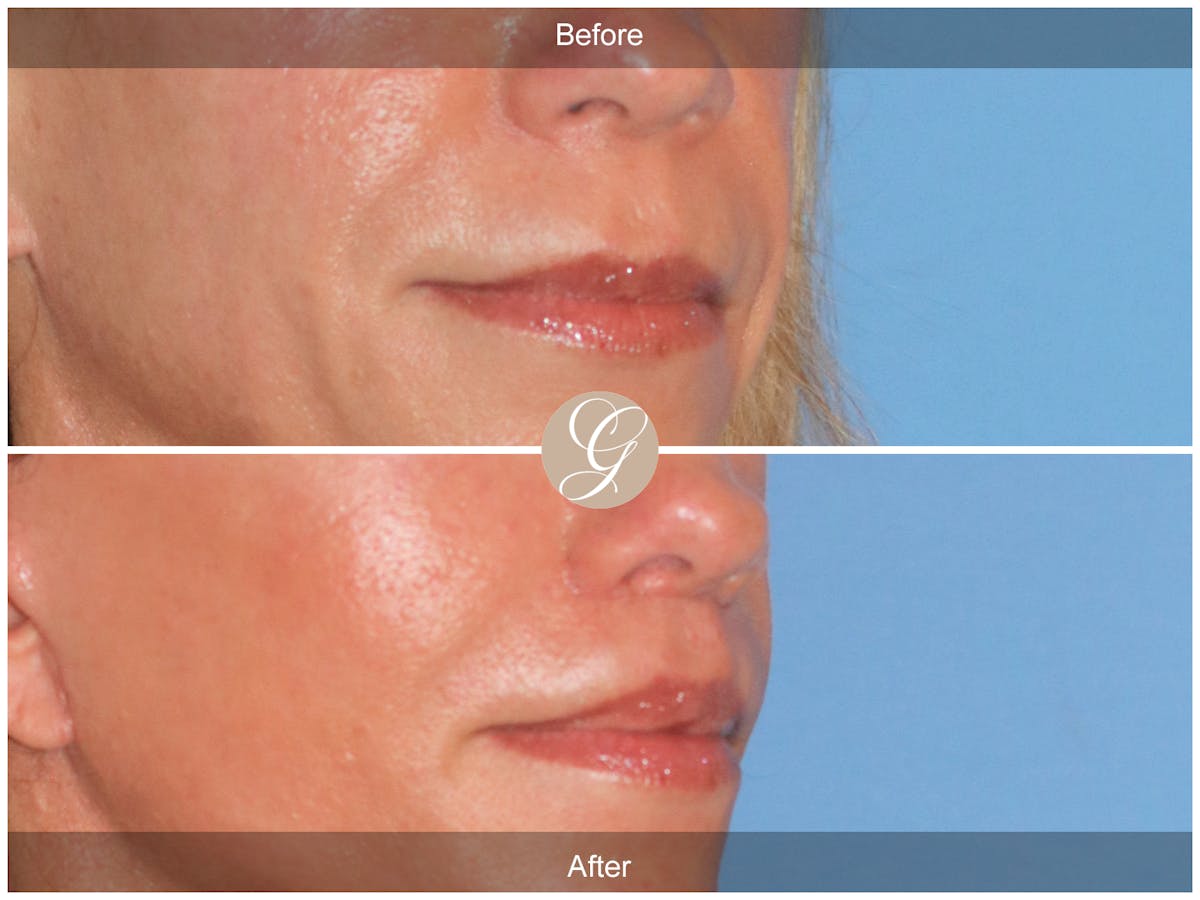 Lip Lift Before & After Gallery - Patient 198068 - Image 2