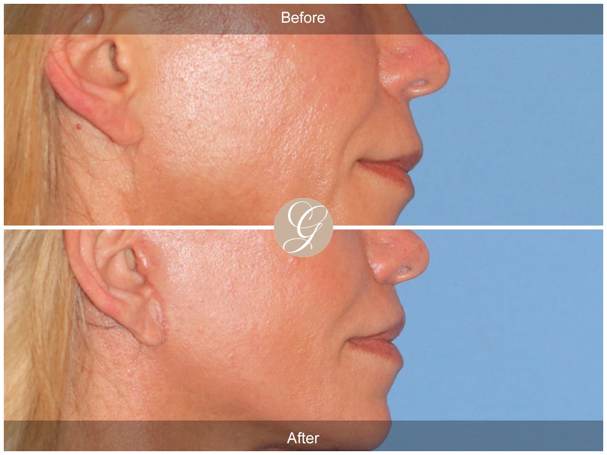 Lip Lift Before & After Gallery - Patient 198068 - Image 3