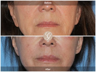 Lip Lift Before & After Gallery - Patient 138678 - Image 1