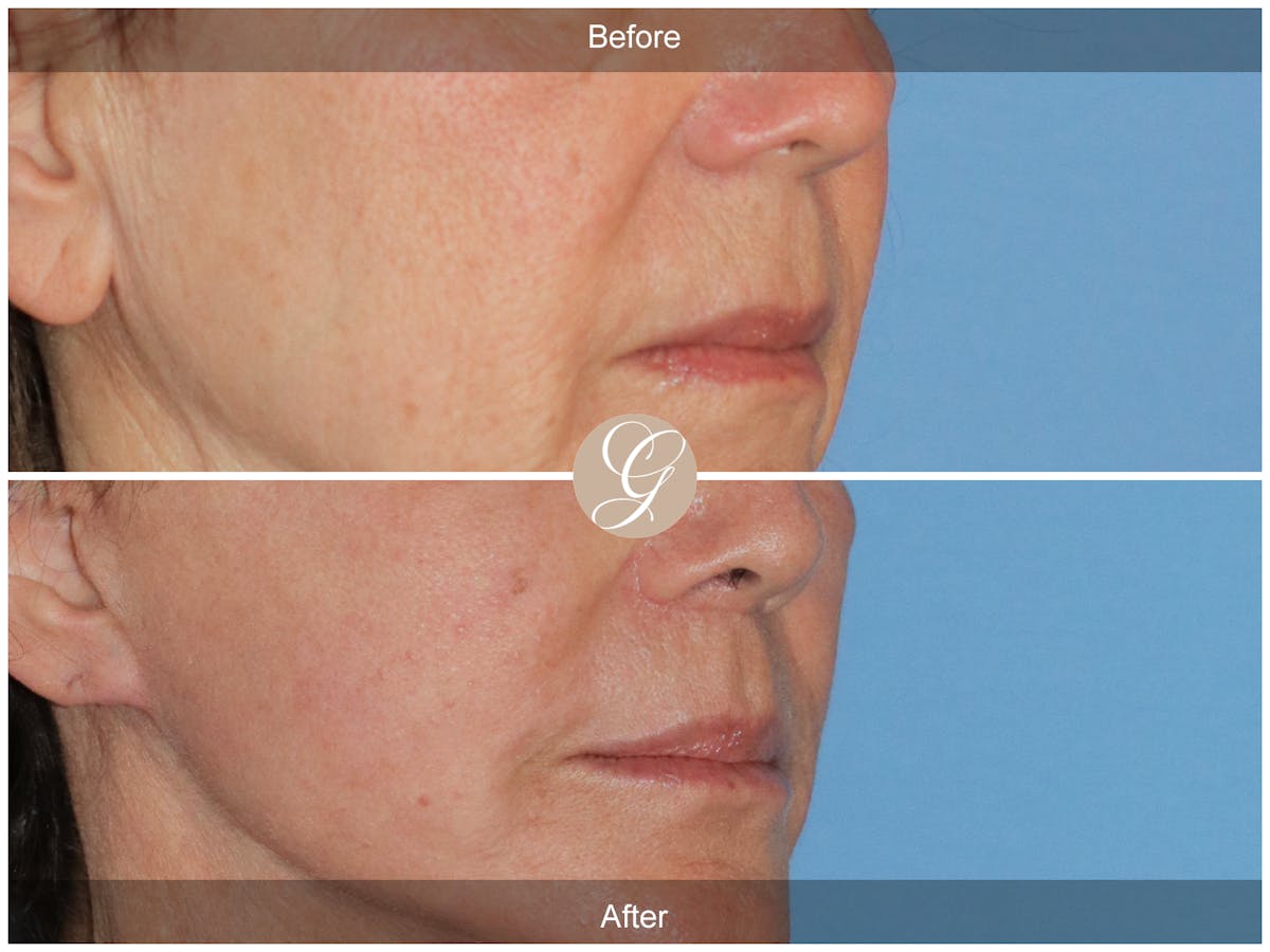 Lip Lift Before & After Gallery - Patient 138678 - Image 2