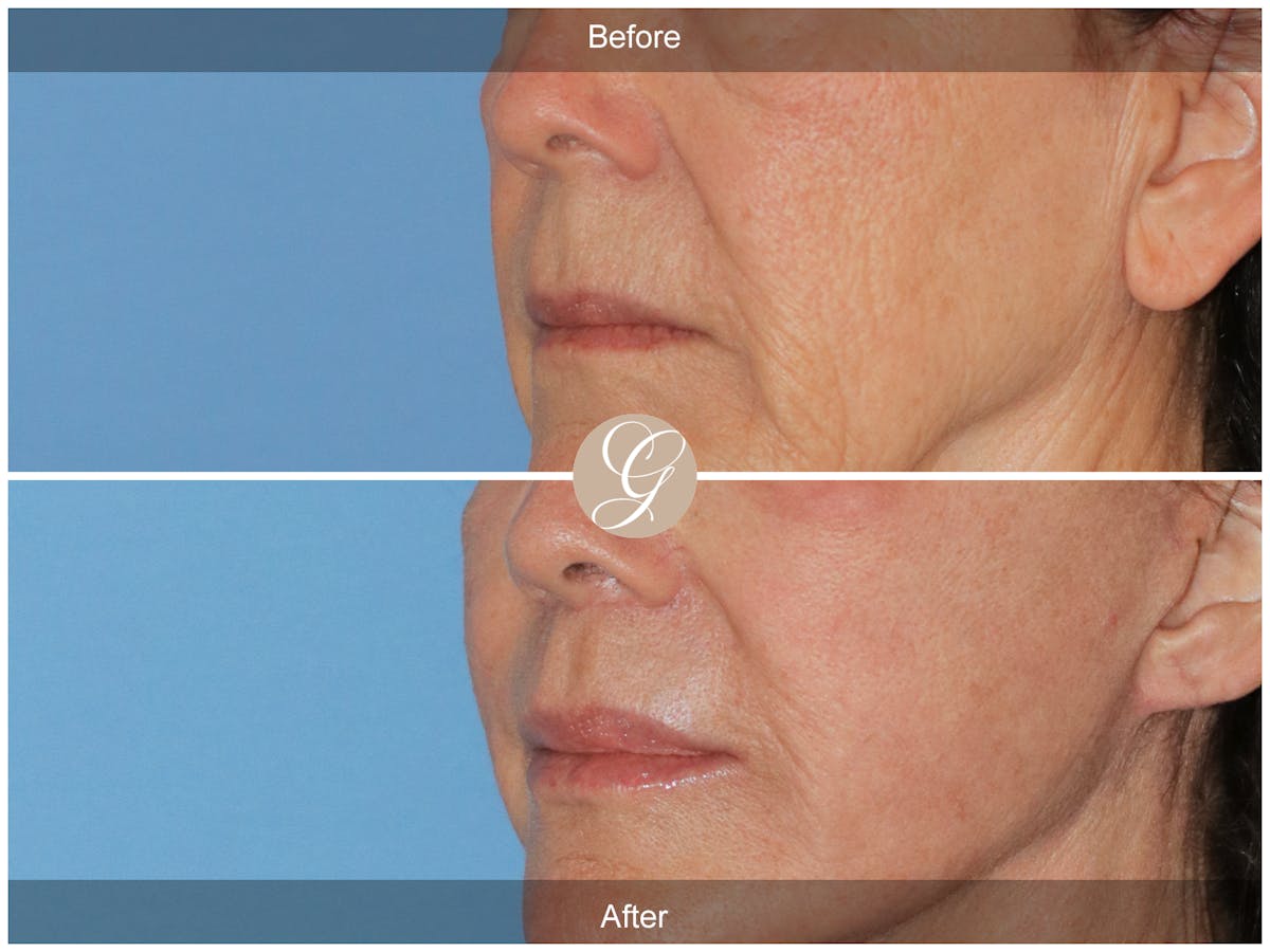 Lip Lift Before & After Gallery - Patient 138678 - Image 3