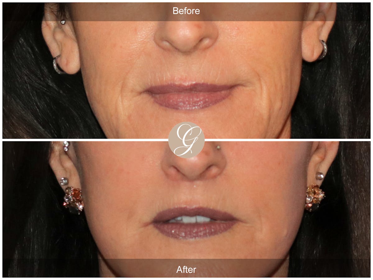 Lip Lift Before & After Gallery - Patient 353487 - Image 1