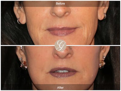 Lip Lift Before & After Gallery - Patient 353487 - Image 1