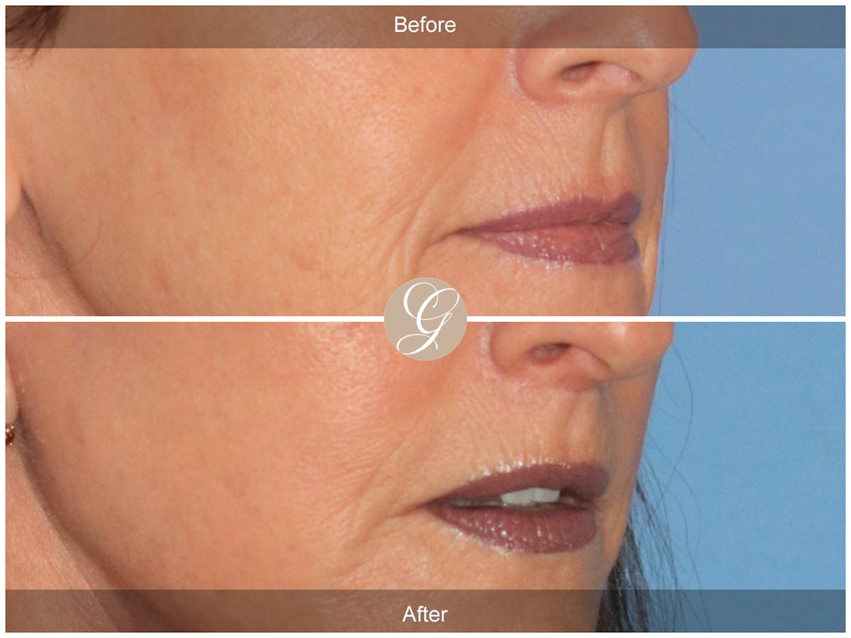 Lip Lift Before & After Gallery - Patient 353487 - Image 2