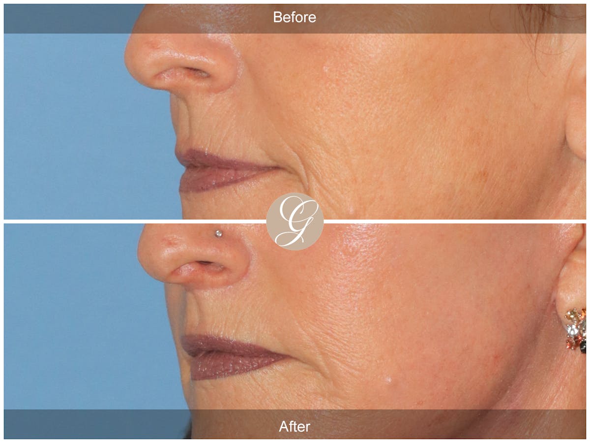 Lip Lift Before & After Gallery - Patient 353487 - Image 3