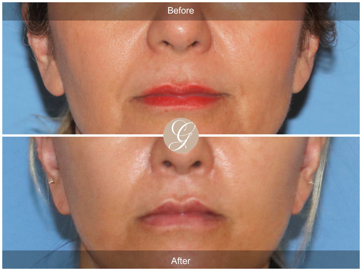 Lip Lift Before & After Gallery - Patient 284852 - Image 1