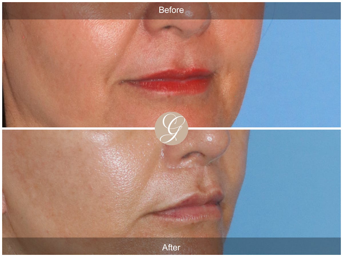 Lip Lift Before & After Gallery - Patient 284852 - Image 2