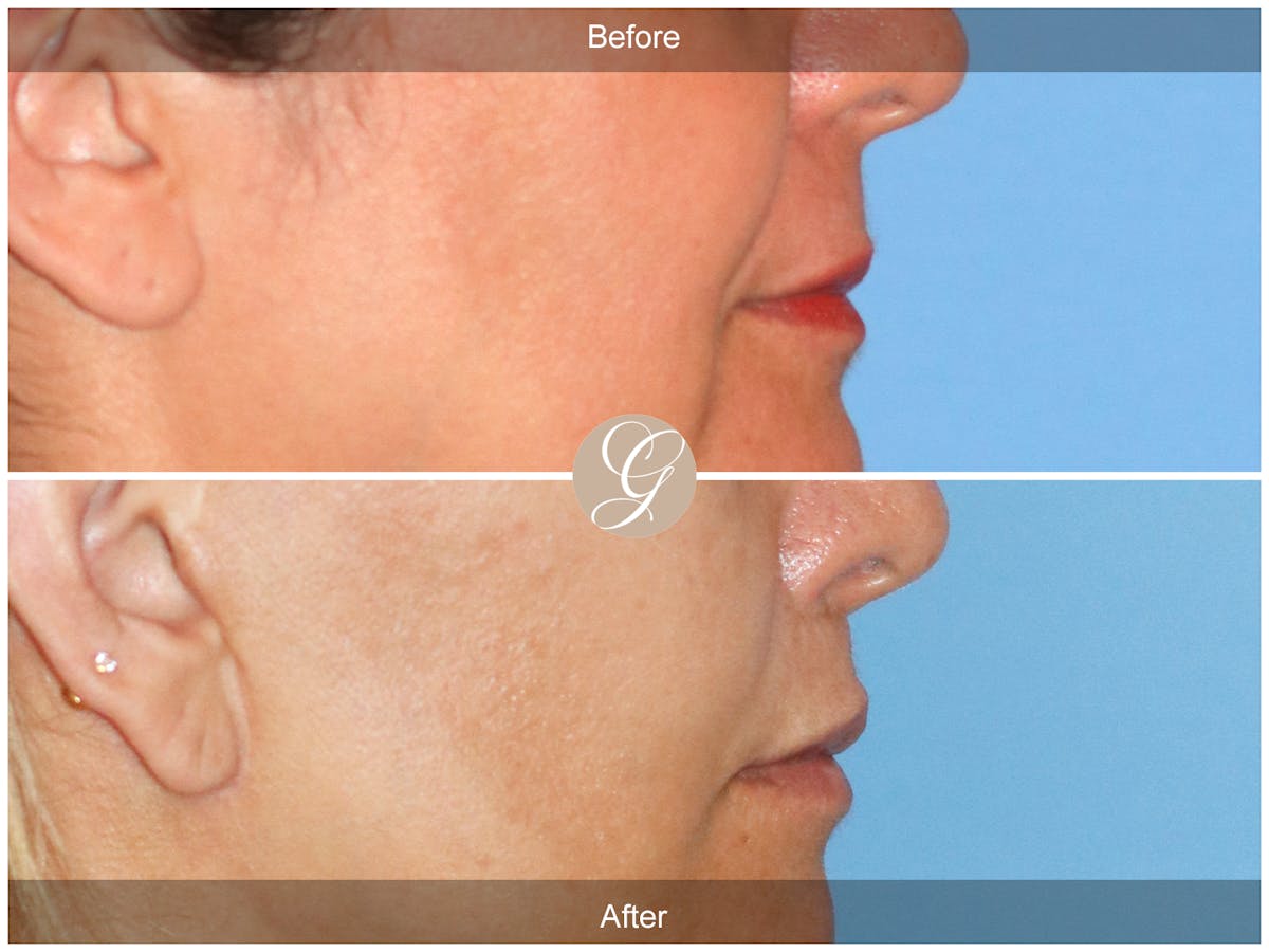 Lip Lift Before & After Gallery - Patient 284852 - Image 3