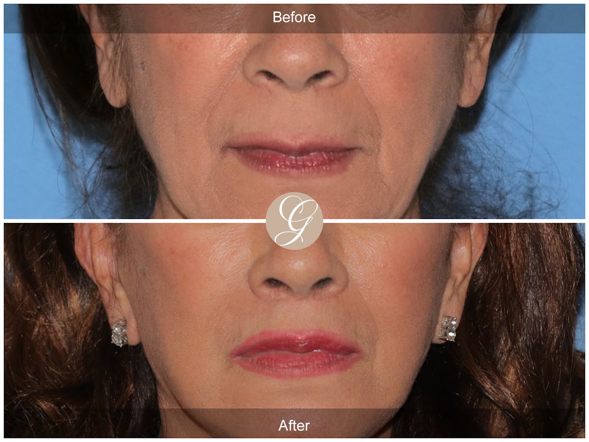 Lip Lift Before & After Gallery - Patient 178658 - Image 1