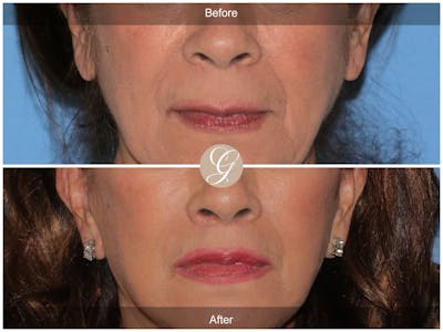 Lip Lift Before & After Gallery - Patient 178658 - Image 1