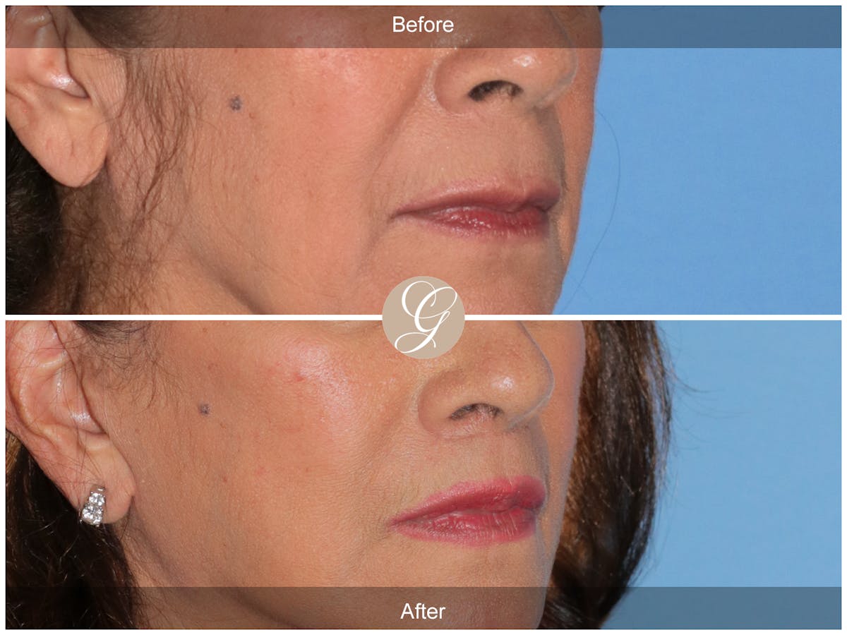 Lip Lift Before & After Gallery - Patient 178658 - Image 2