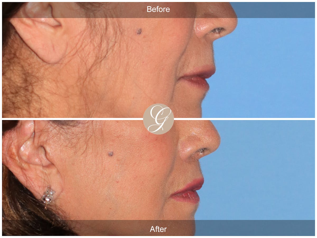 Lip Lift Before & After Gallery - Patient 178658 - Image 3