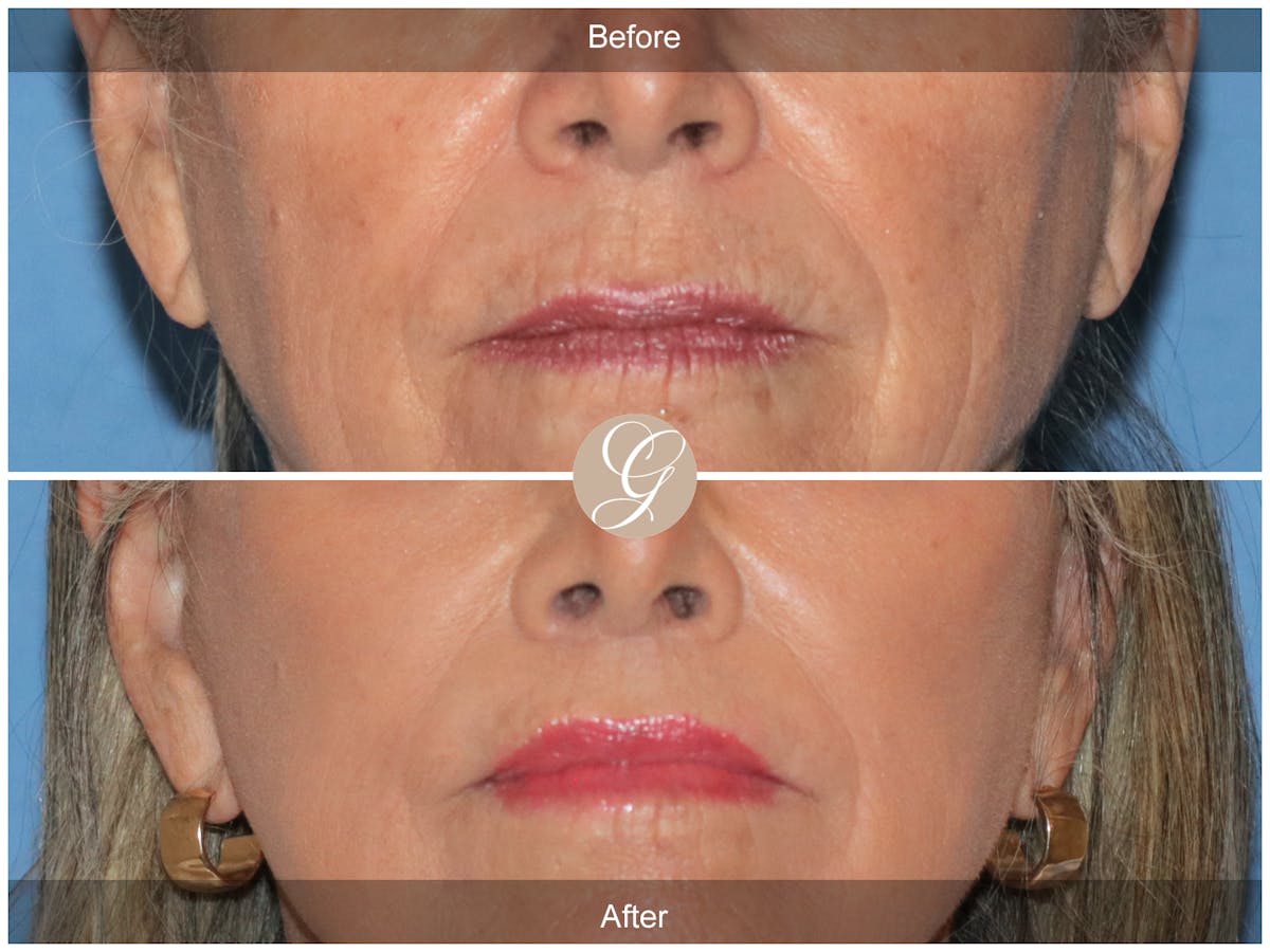 Lip Lift Before & After Gallery - Patient 355661 - Image 1
