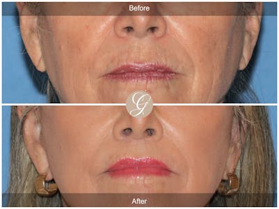 Lip Lift Before & After Gallery - Patient 355661 - Image 1