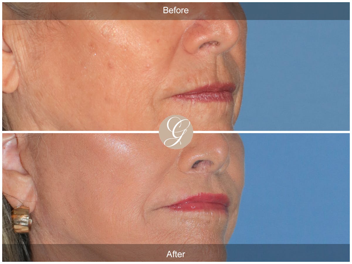 Lip Lift Before & After Gallery - Patient 355661 - Image 2