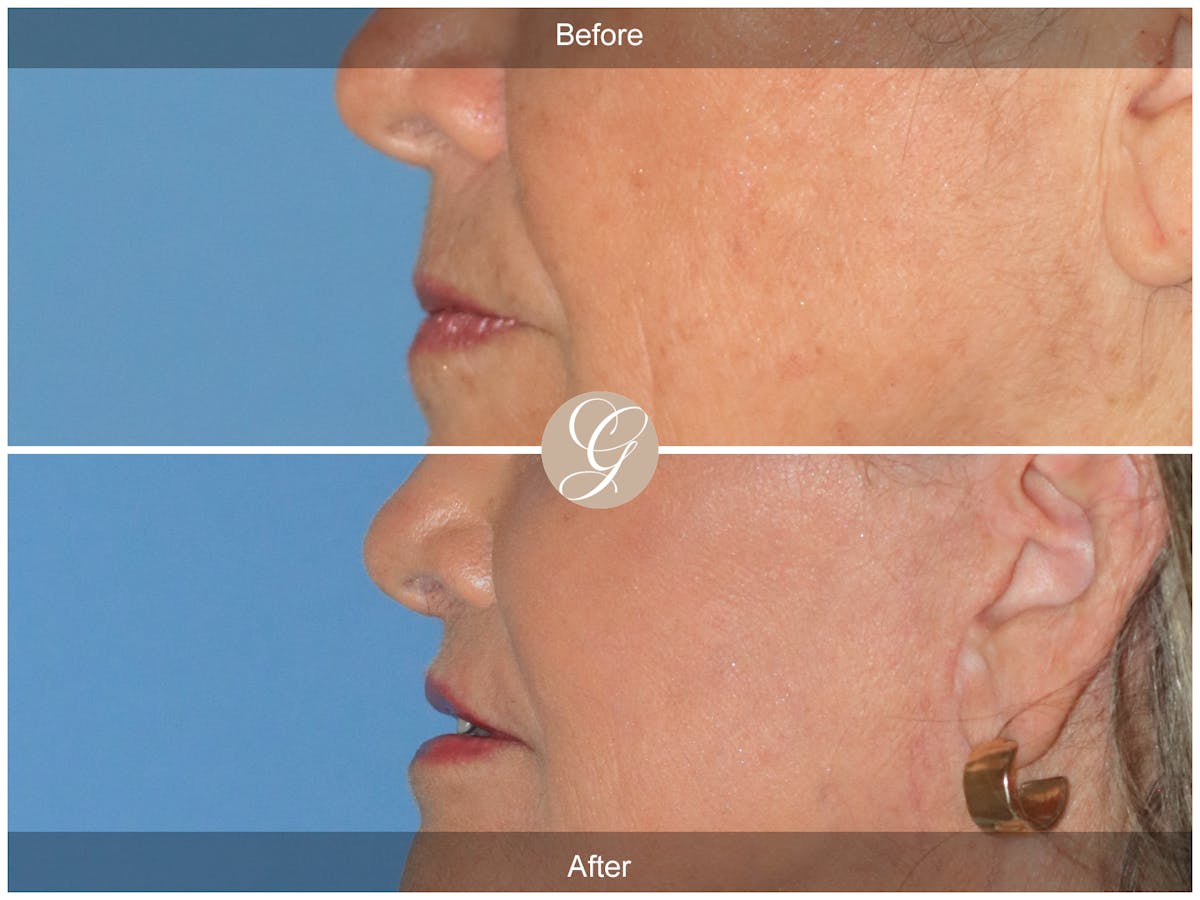 Lip Lift Before & After Gallery - Patient 355661 - Image 3