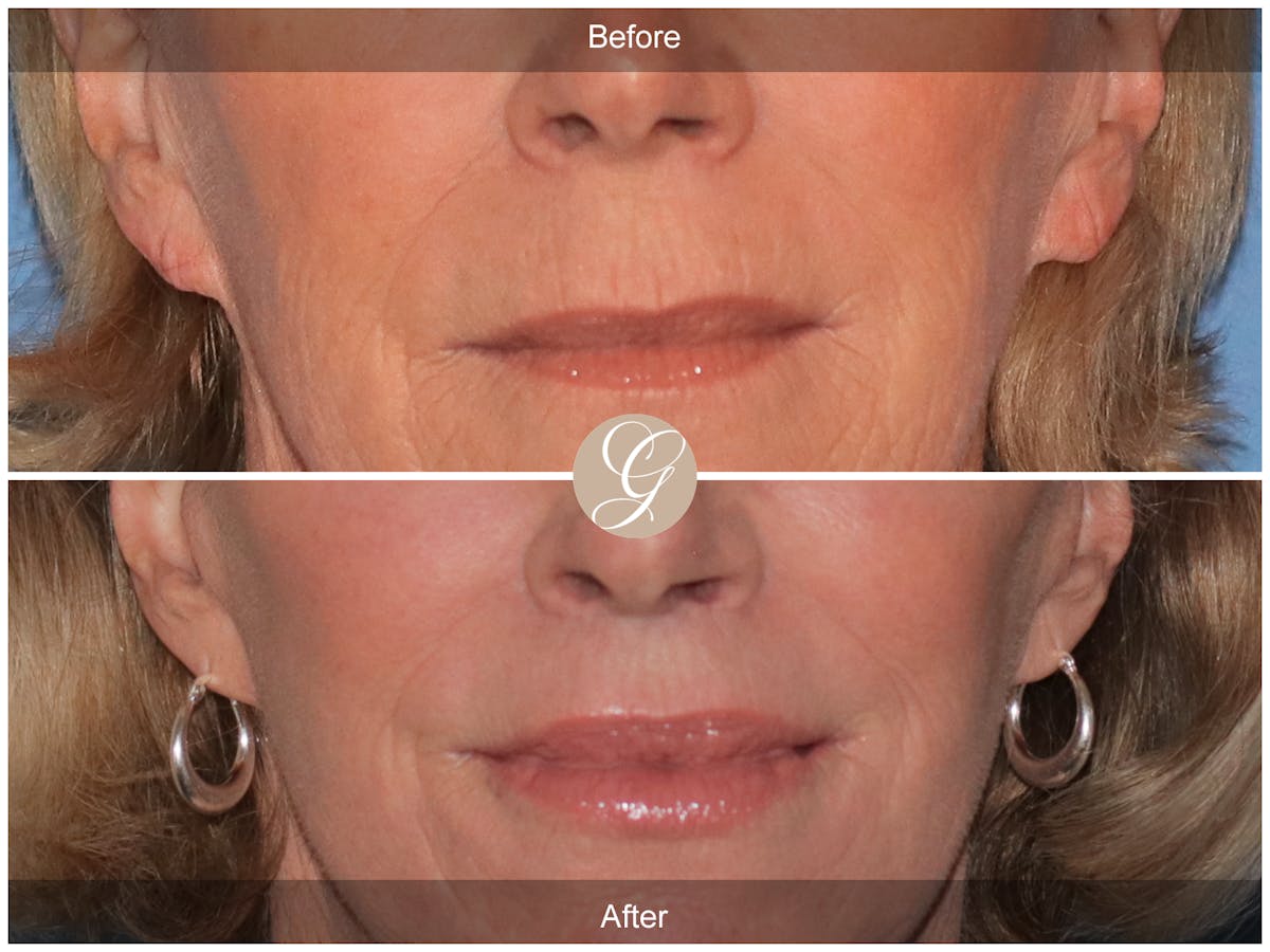 Lip Lift Before & After Gallery - Patient 351405 - Image 1