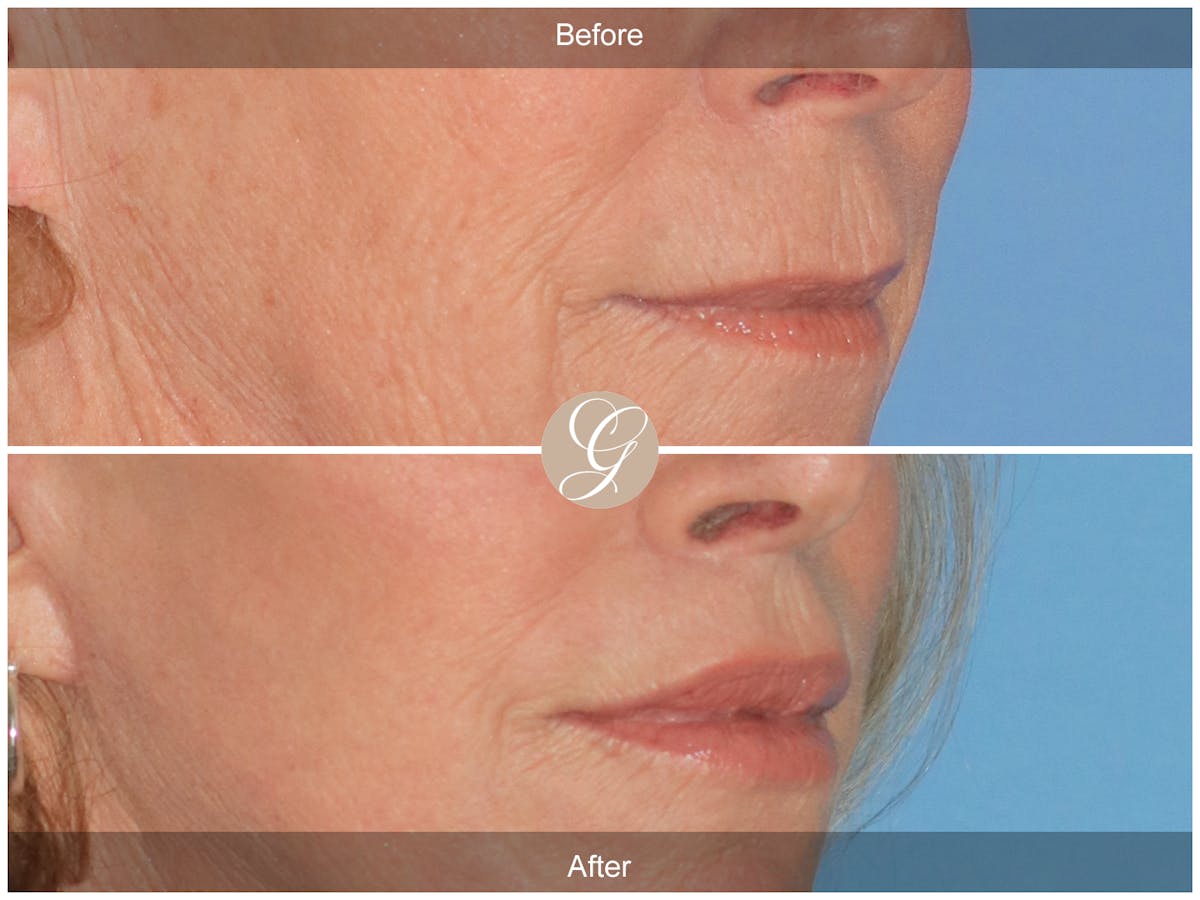 Lip Lift Before & After Gallery - Patient 351405 - Image 2