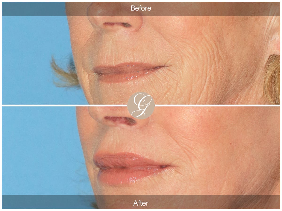 Lip Lift Before & After Gallery - Patient 351405 - Image 3