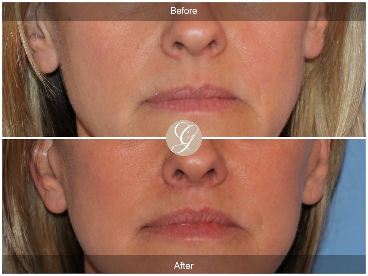 Lip Lift Before & After Gallery - Patient 231859 - Image 1