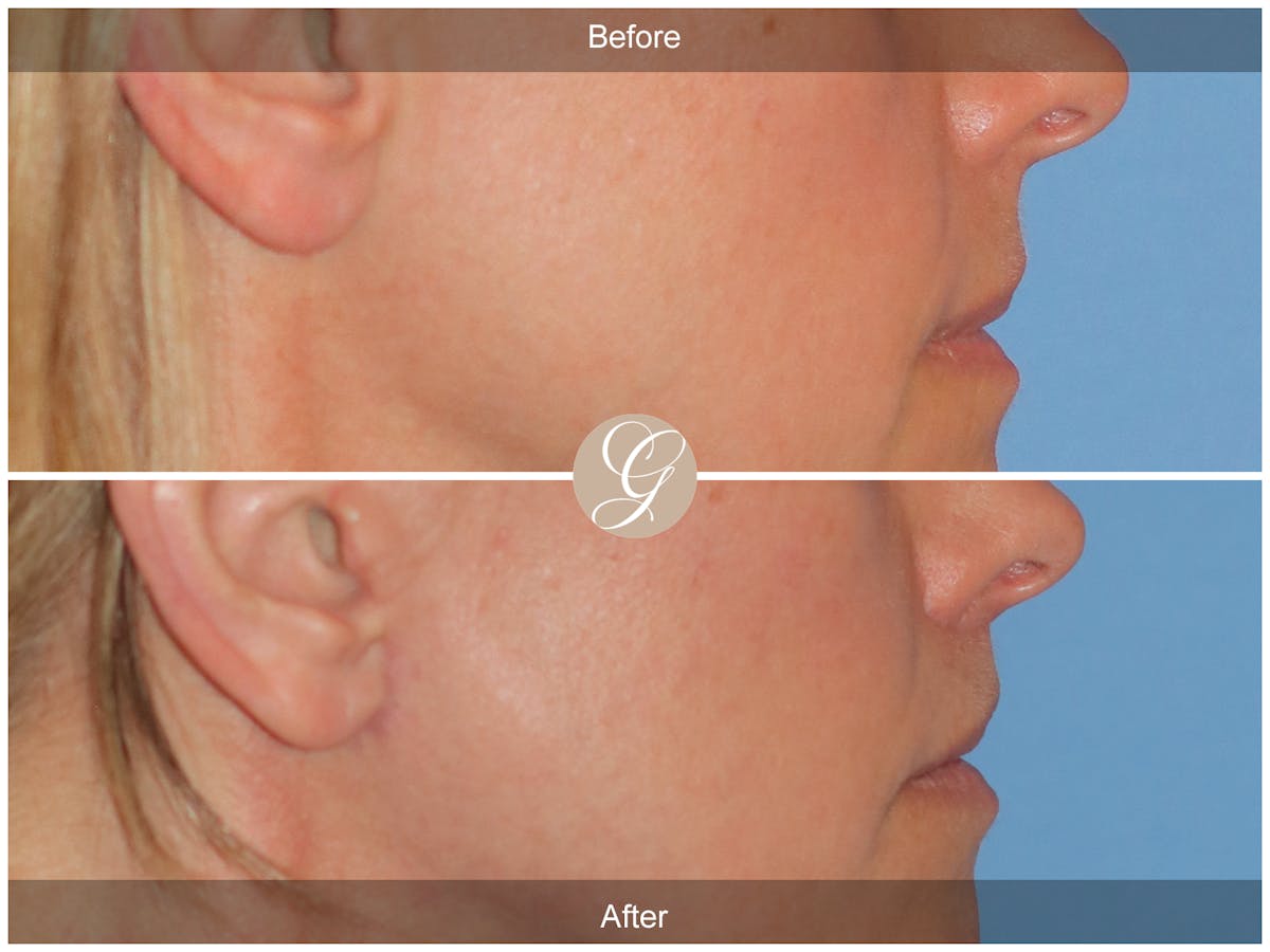 Lip Lift Before & After Gallery - Patient 231859 - Image 3