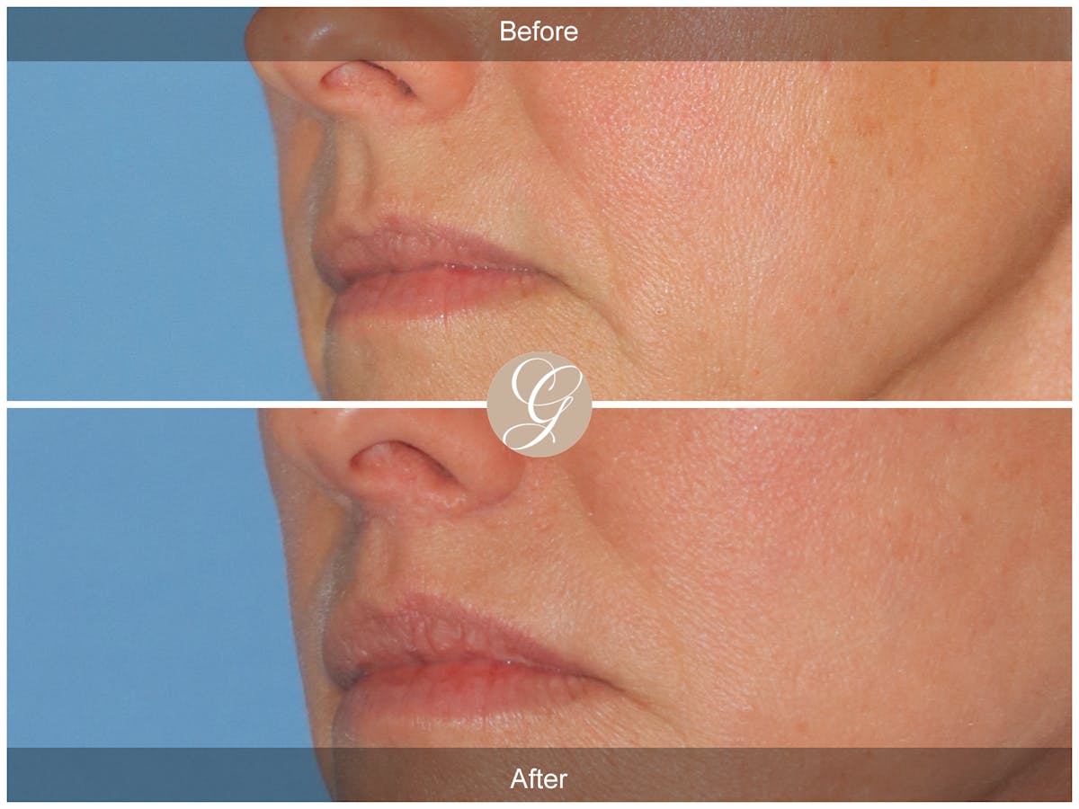 Lip Lift Before & After Gallery - Patient 231859 - Image 2