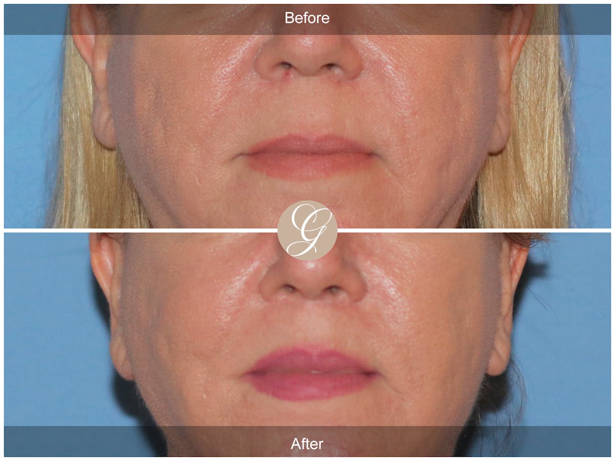 Lip Lift Before & After Gallery - Patient 173708 - Image 1