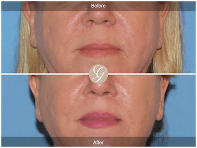 Lip Lift Before & After Gallery - Patient 173708 - Image 1