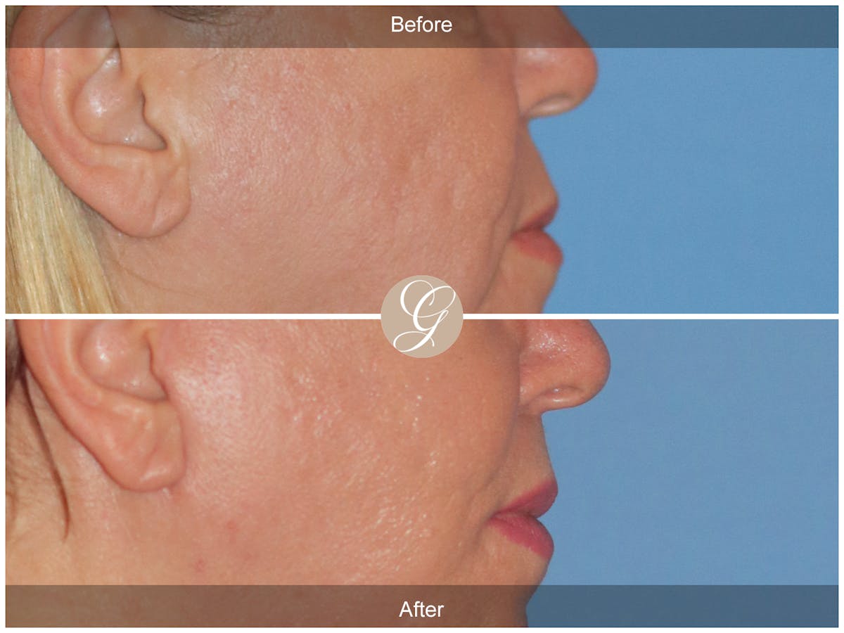 Lip Lift Before & After Gallery - Patient 173708 - Image 2