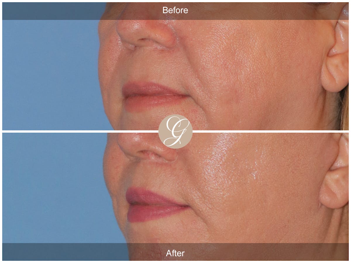 Lip Lift Before & After Gallery - Patient 173708 - Image 3