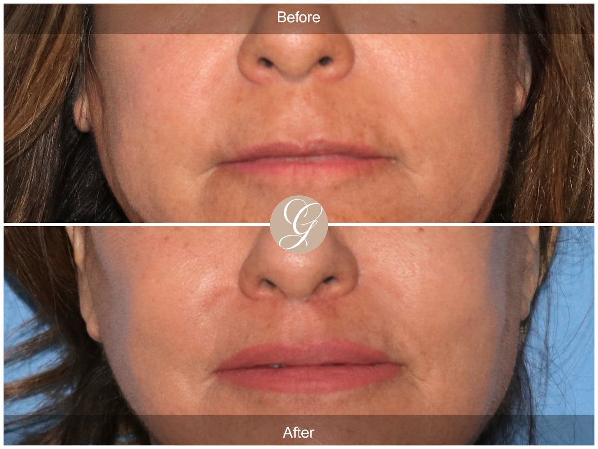 Lip Lift Before & After Gallery - Patient 381653 - Image 1