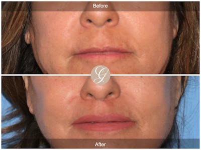 Lip Lift Before & After Gallery - Patient 381653 - Image 1